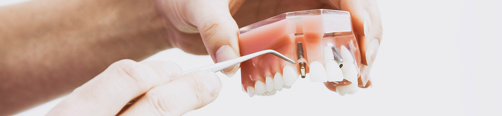 Zahnärztliche Gemeinschaftspraxis Za. Torsten Bast und Dr. Daniel Stute - Implantologie